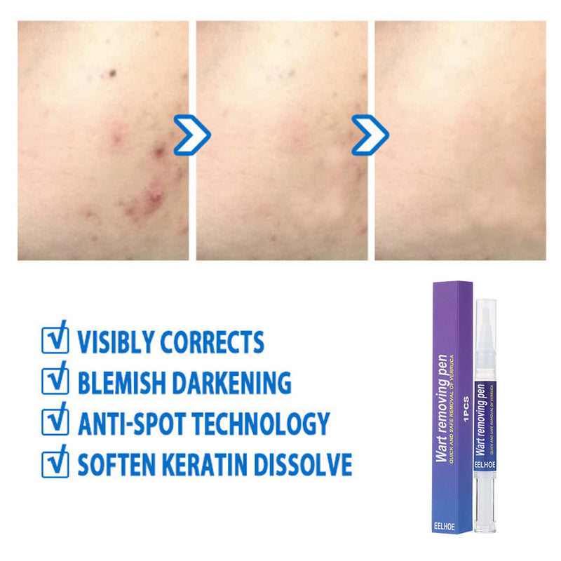 Wart Removing Pen