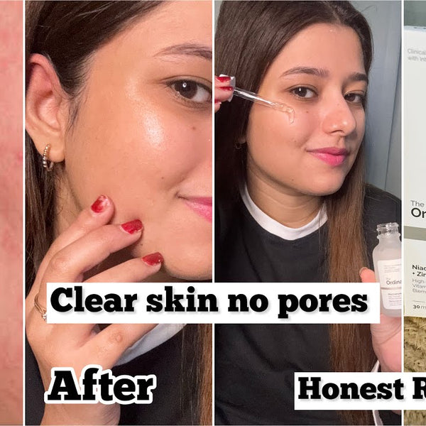 The Ordinary Niacinamide 10% + Zinc 1% Anti-Blemish Serum